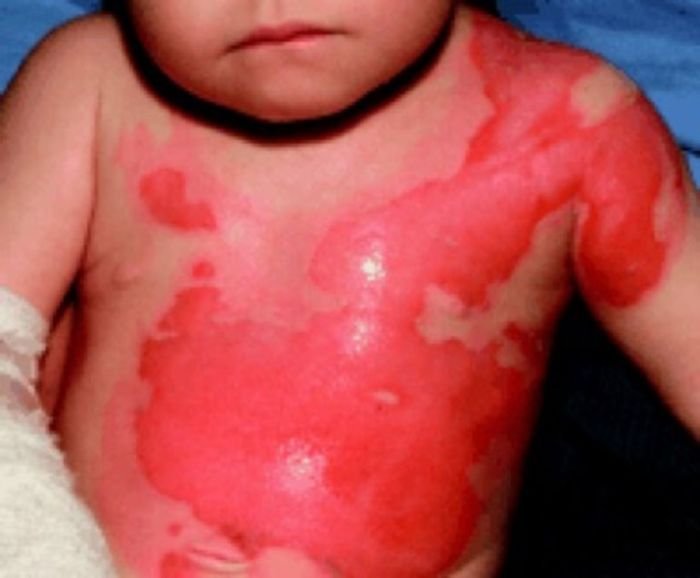 Burned burn injury burns baamboozle pngitem burnt gout injuries aid