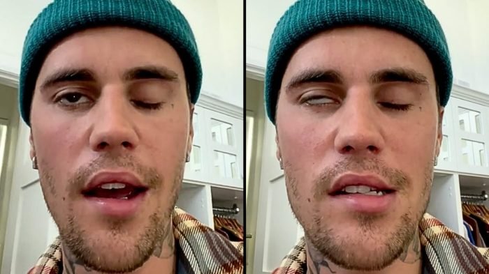 Justin bieber health
